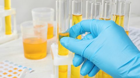A lab tech analyzing urine color in test tubes | Urology Associates | Denver, CO