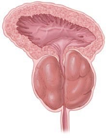 Enlarged Prostate